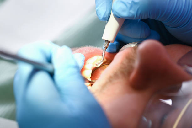 Best Emergency Dentist for Knocked-Out Tooth in Le Grand, CA